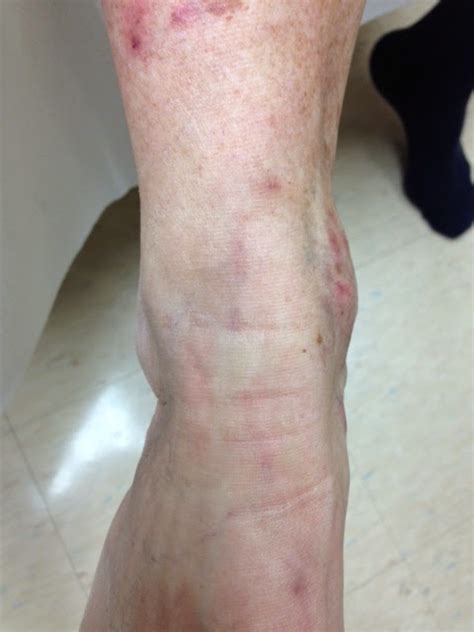 Effective Treatment Of Foot And Ankle Varicose Veins Cvl