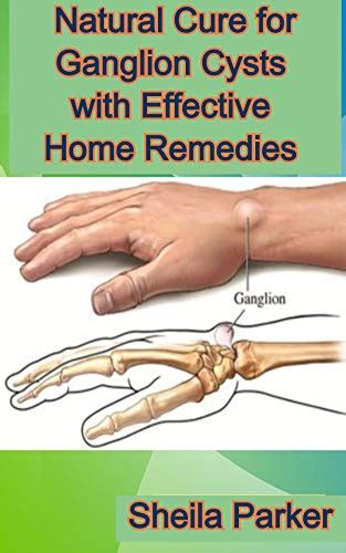 Natural Cure For Ganglion Cysts With Effective Home Remedies By Sheila