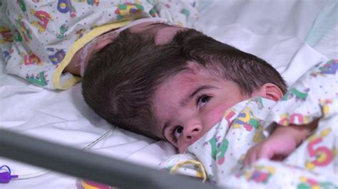 Conjoined Twins Separated Successfully After More Than 50 Hours Of Surgery