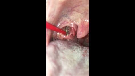 More Huge Tonsil Stone Removal Self Removal Of Tonsil Stones Lots Of