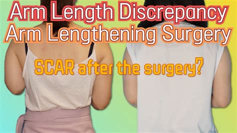 Arm Length Discrepancy Arm Lengthening Surgery Youtube