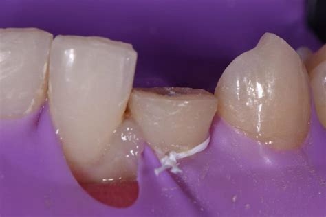 Enamel Dentin Fracture