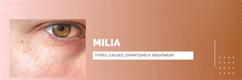 Milia Types Causes Symptoms And Treatment Ushc