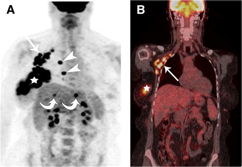 Retrospective Study Of 18f Fdg Petct In The Diagnosis Of Inflammatory