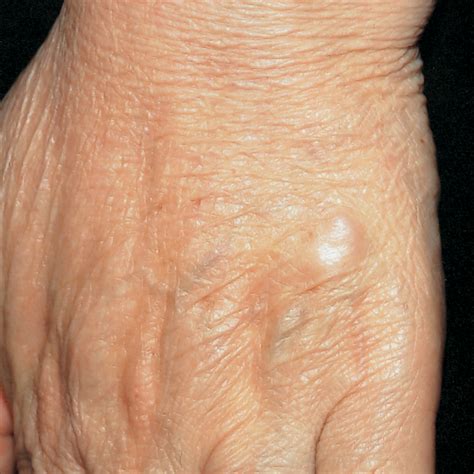A Freely Movable Subcutaneous Nodule On The Dorsum Of The Hand—quiz