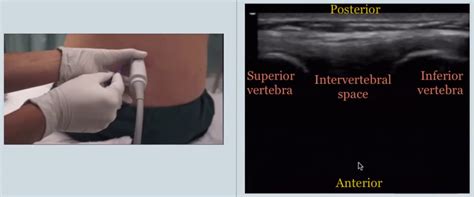 Ultrasound Guidance For Lumbar Puncture — Nuem Blog