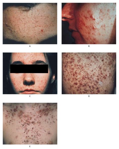 Therapy For Acne Vulgaris Nejm