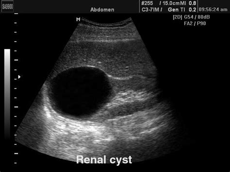 Ultrasound Images • Renal Cyst B Mode Echogramm №163