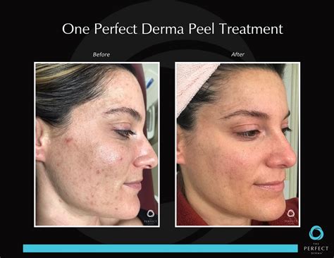 The Perfect Peel Facial Peel Weston Skincare Clinic