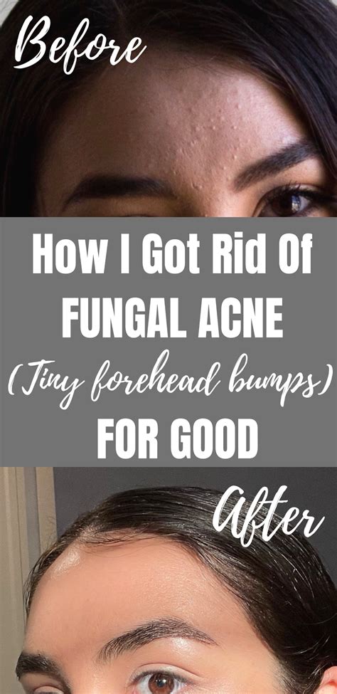 Small Pimples On Face Skin Bumps On Face Head Pimples Face Acne