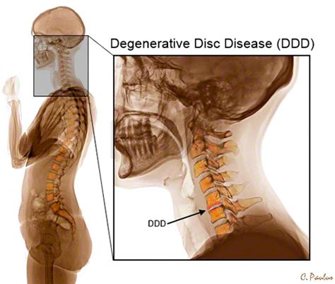Recovering From Herniated Cervical Disc Neck And Spine Disease