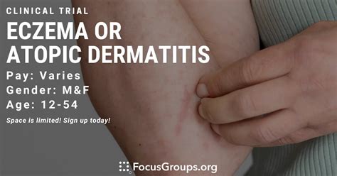 Eczema Atopic Dermatitis Clinical Trial Dms