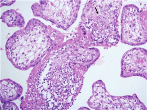 Placenta With Hydropic And Necrotic Villi The Areas Of Necrosis Showed