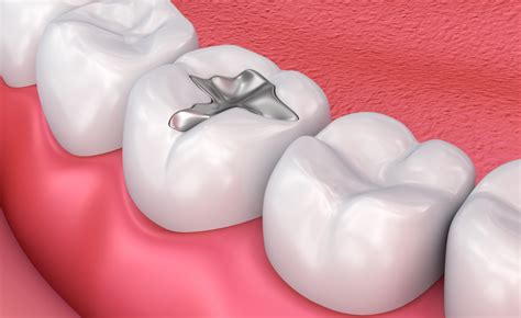 Maybe you would like to learn more about one of these? Dental Implants Leicester | FREE Initial Consultation