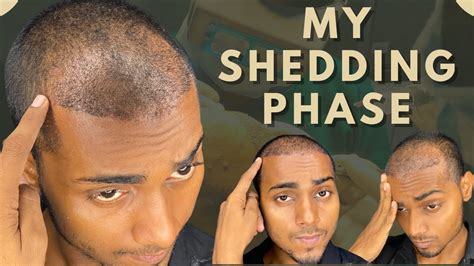 Shedding Phase My Shedding Phase After 20 Days Of Hair Transplant