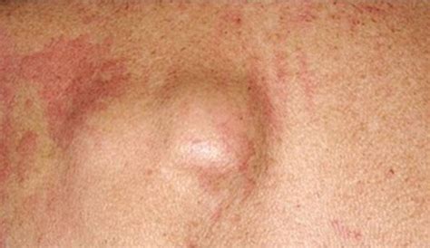 Skin Lumps SeeReadShare