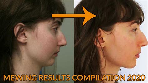 Mewing Side Profile Results Beforeafters Youtube