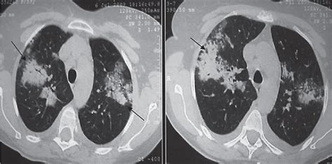 Figure 1 From A Case Of Churg Strauss Syndrome Treated With Montelukast