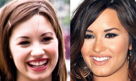 Demi Lovato Nose Job Before And After Plastic Surgery Photos