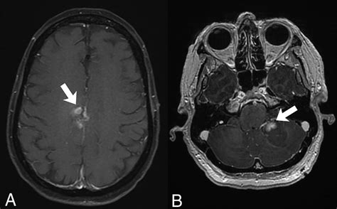 Dynamic Contrast Enhanced Mri In Patients With Brain Metastases