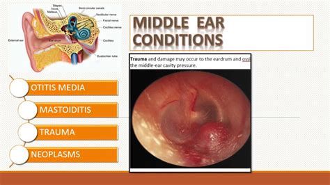 Common Ear Disorders