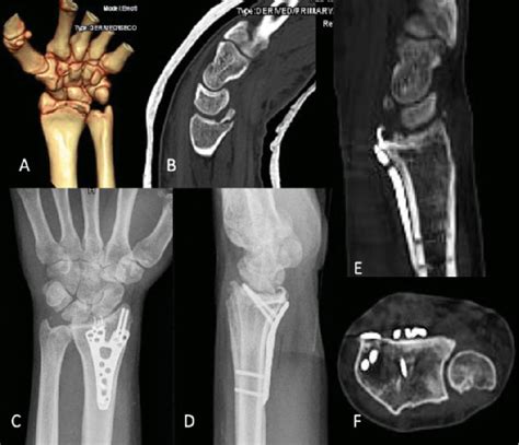A D A Three Fragment Articular Fracture Of The Distal Radius E F