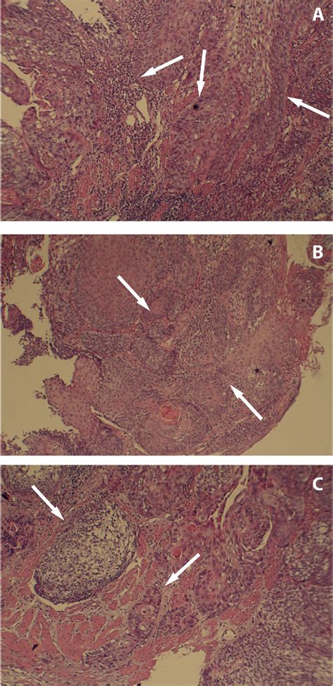 Figure 1 From Synchronous Triple Squamous Cell Carcinoma Of The