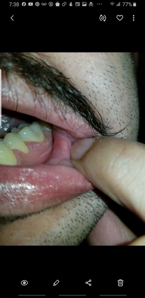 Herpes On The Gum Line Herpes Non Genital Forums Patient