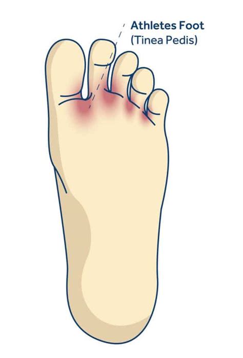 Athletes Foot Tinea Shellharbour Podiatry Your Local Podiatrists