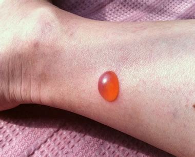 Maybe you would like to learn more about one of these? 虫刺されで水ぶくれになった時の治し方は、塗り薬 ...