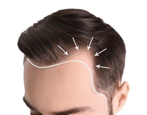 NeoGraft Hair Transplant Benefits Ultimate Image Cosmetic Medical Center