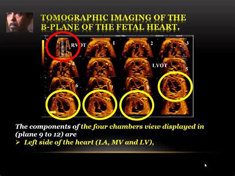 Tomographic Ultrasound Imaging Tui Of The Fetal Heart Youtube