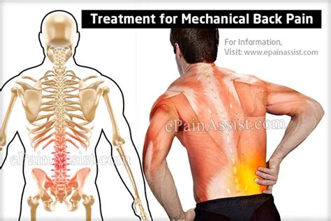What Can Cause Mechanical Back Pain And How Is It Treated