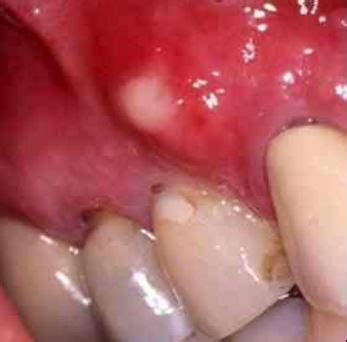 White Spots On Gums On Baby Painful Small White Bumps Patches Dots