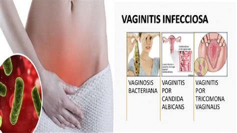 Vaginosis Bacteriana Vaginitis Como Curarla Infecciones My Xxx Hot Girl