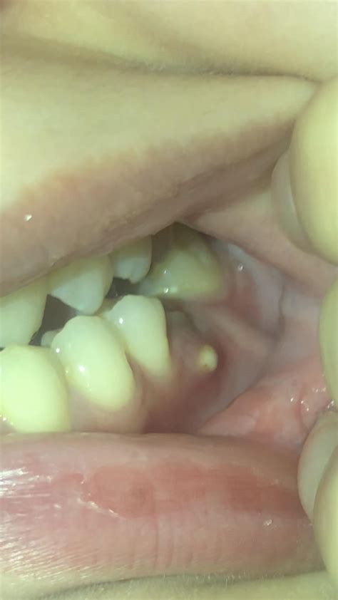 White Painless Bump On Gum Raskdentists