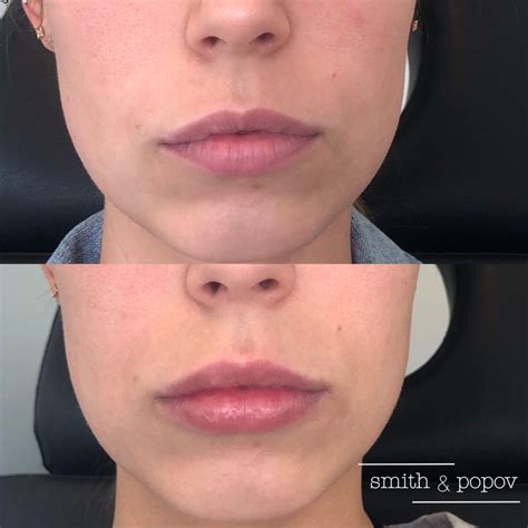 Pin By Danielle Smith Np On Botox And Filler Danielle Smith Np Botox