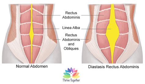What You Need To Know About Diastasis Recti Thrive Together Womens Fitness