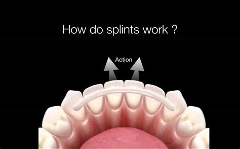 How Do Dental Splints Work Youtube