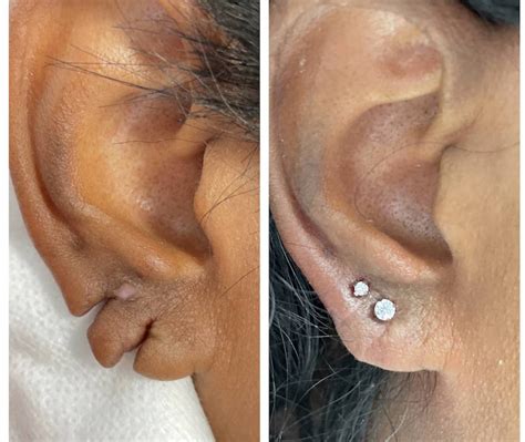 Earlobe Plastic Surgery Before And After Earlobe Repair Before And