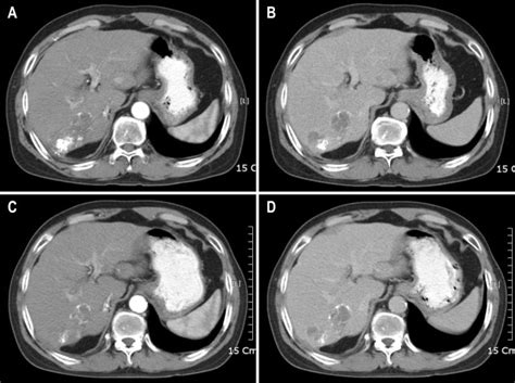 Abdominal Arterial Phase Ct Showing The New 1 Cm Enhanced Hcc In The