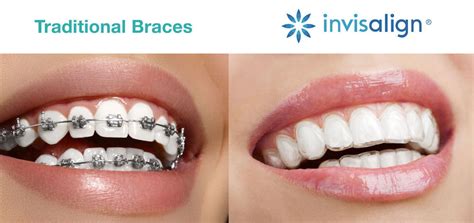 Invisalign Vs Braces Which Choice Is Right For You Arrow Smile Dental