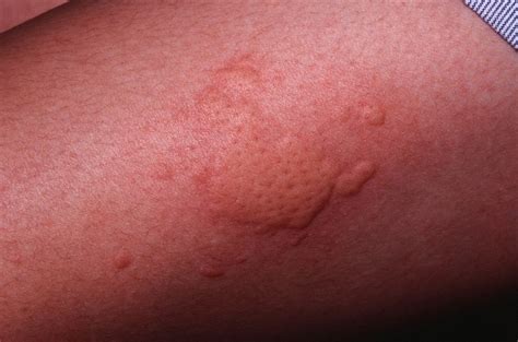 Chronic Hives Causes Symptoms And Treatment