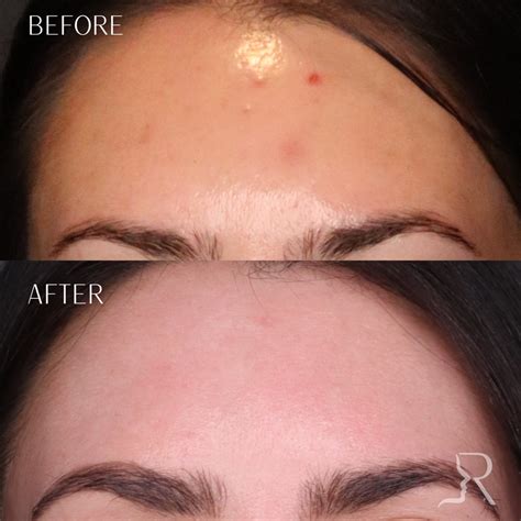 Laser Skin Resurfacing Before And Afters Roberts Aesthetic And Wellness