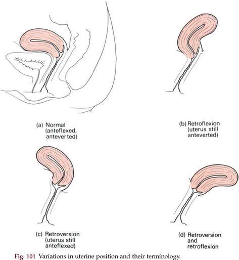 The Female Genital Organs Uterus Retroverted Uterus Ultrasound