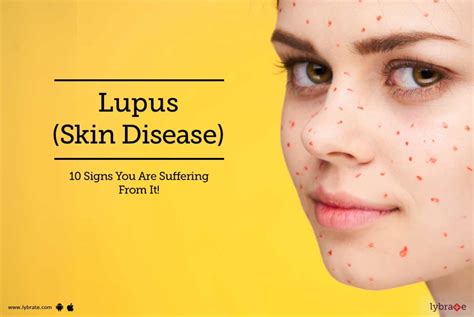 Everything You Need To Know About Lupus Ph