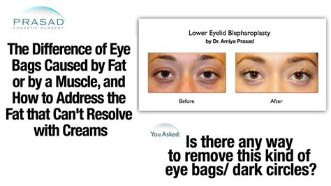 Types Of Eye Bags