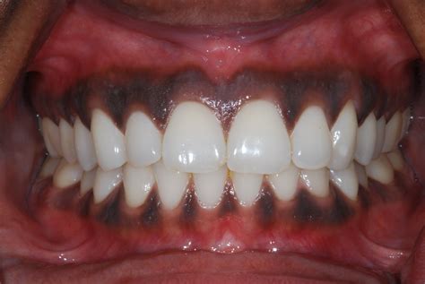 Gum Bleaching Is It For You Dental Implants Chrysalis Dental