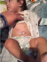 Baby Eczema Flare Up Treatment Photos