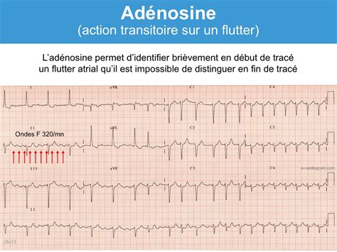 Adénosine Atp Indications E Cardiogram